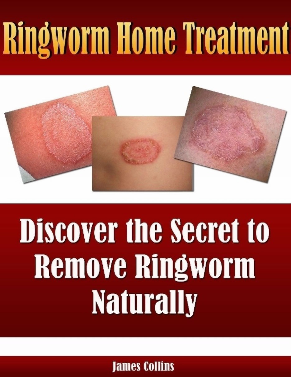 Ringworm Home Treatment: Discover The Secret To Remove Ringworm 